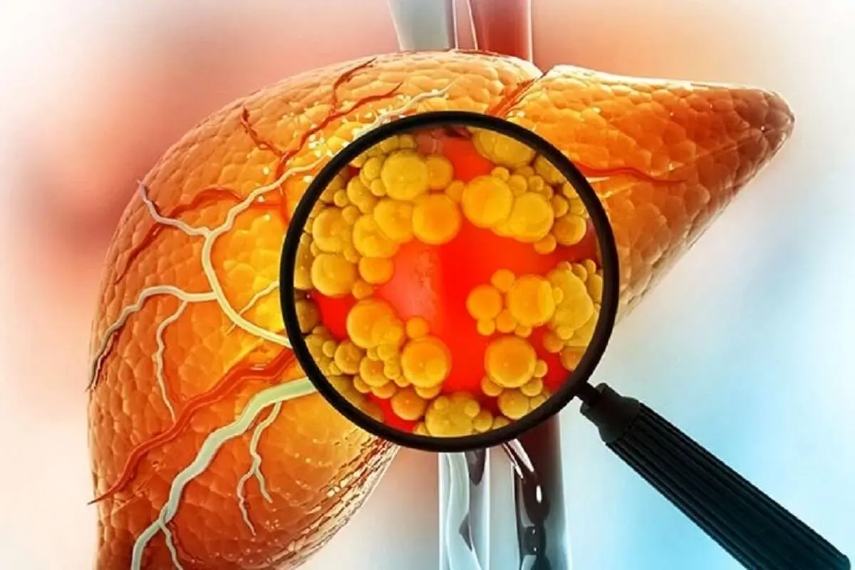 هشدار دفتر بهبود تغذیه جامعه وزارت بهداشت به درمان نادرست کبد چرب