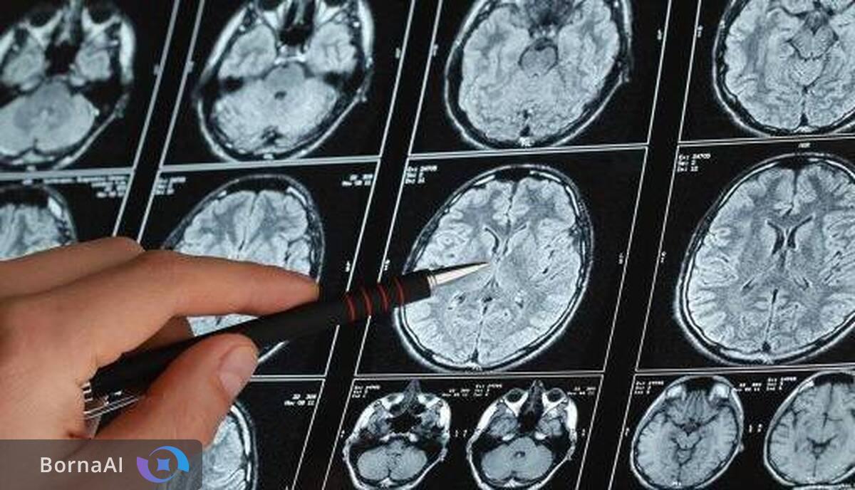 تراشه‌ای نوین برای رصد لحظه‌ای آلزایمر طراحی شد!