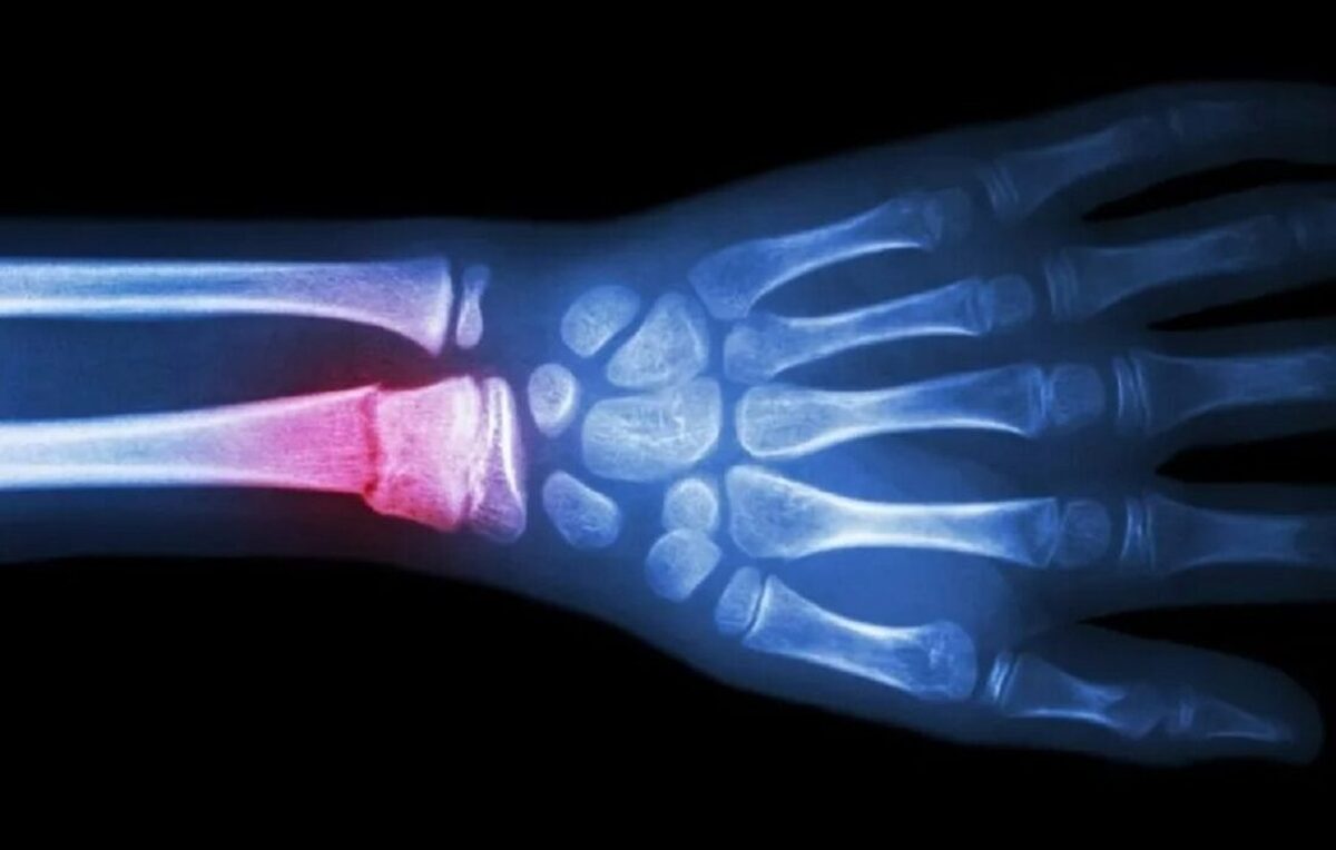 ترمیم استخوان شکسته با یک تفنگ درمانی!؛ گزینه ای سریع تر و مقرون به صرفه تر برای ترمیم