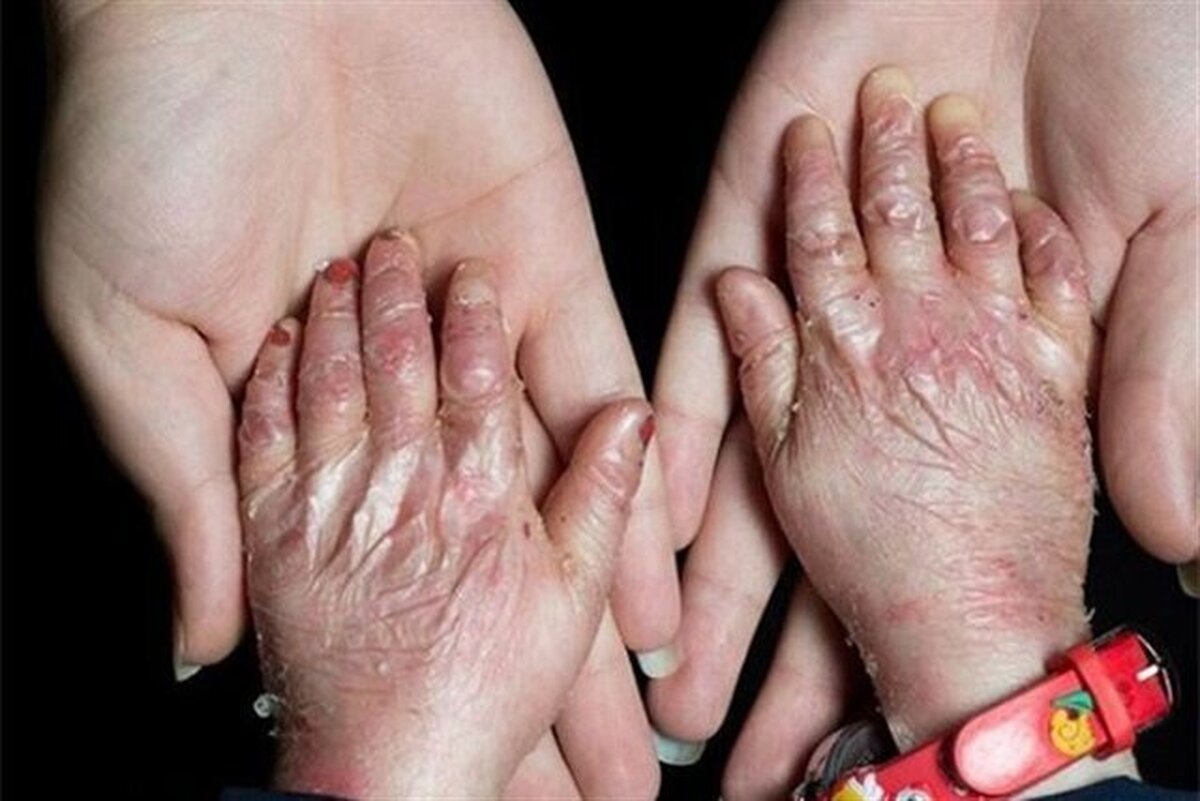 دانش‌آموزان پروانه‌ای از تحصیل در کنار همسالانشان محروم نمی‌شوند