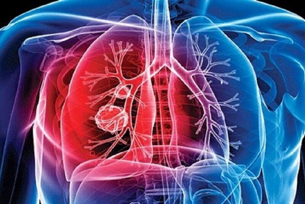 تشخیص و درمان بیماری سل در شبکه بهداشتی کشور رایگان است