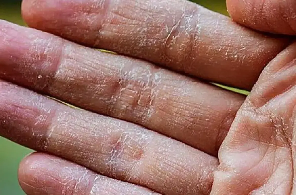 ۱۲ علت شایع پوسته‌پوسته شدن پوست