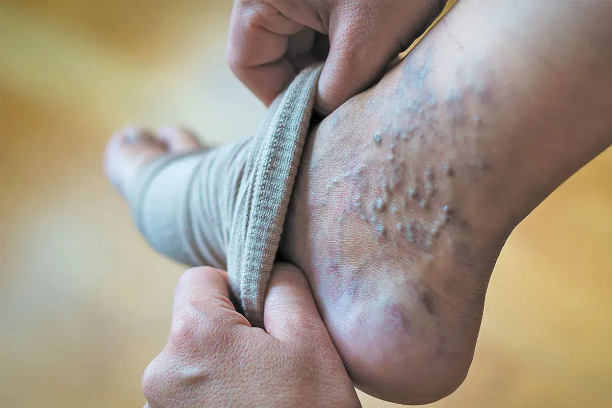 واریس پا: خودمراقبتی و روش‌های خانگی موثر