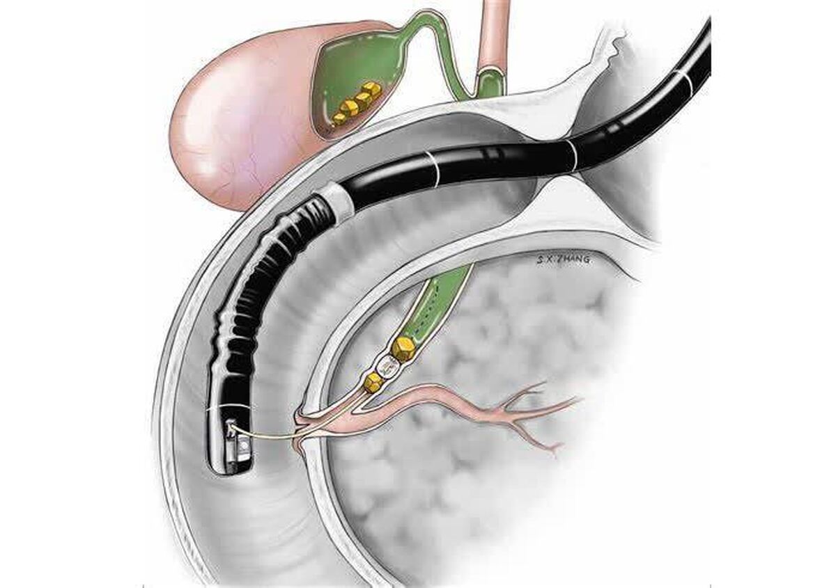 نصب پیشرفته‌ترین دستگاه کلانژیوسکوپی مجاری صفراوی در بیمارستان ابوعلی سینا شیراز