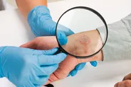تاکید متخصص پوست بر ضرورت تشخیص زودهنگام ضایعات مشکوک پوستی