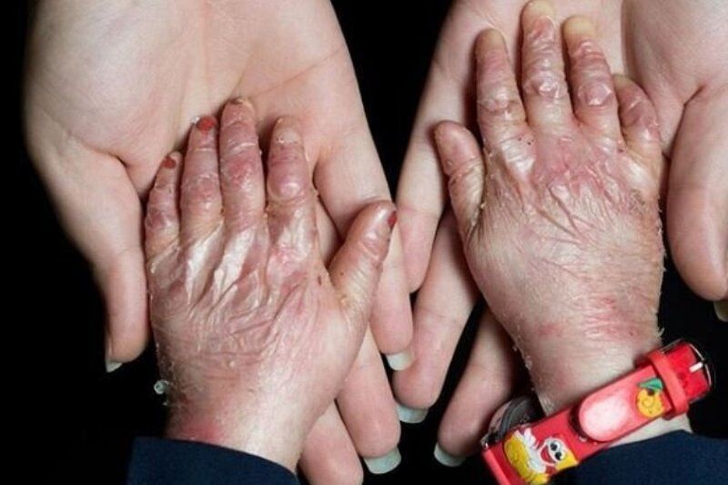 40 هزار بیمار نشان دار تحت پوشش خدمات درمانی بیمه سلامت در استان قزوین هستند