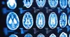 افزایش امنیت هوش مصنوعی در تحلیل MRI مغز با راه حل پژوهشگران ایرانی