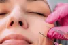 هشدار درباره تزریق فیلر در نواحی فاقد مجوز
